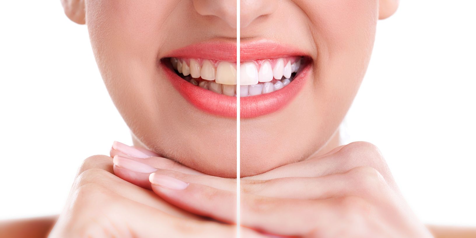 Comparación del color dental antes y después de un blanqueamiento
