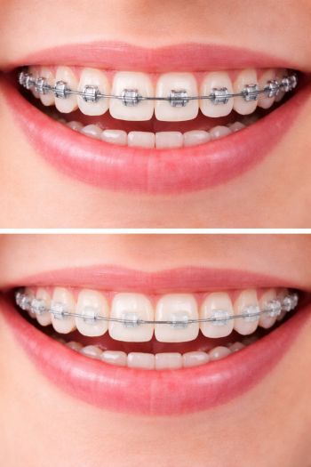 Paciente con brackets metálicos de ortodoncia