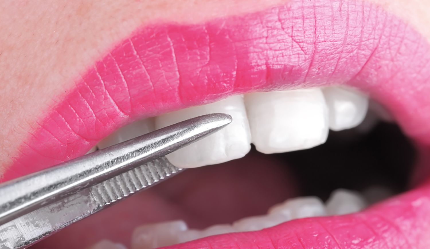 Colocación de una carilla dental de porcelana