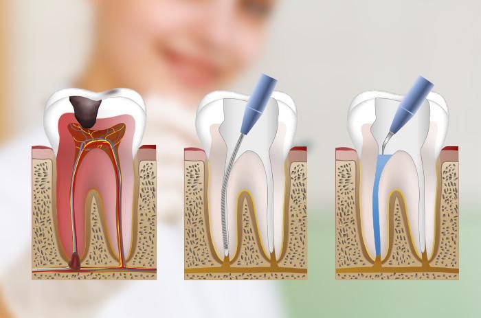 Esquema de los conductos radiculares tratados en una endodoncia