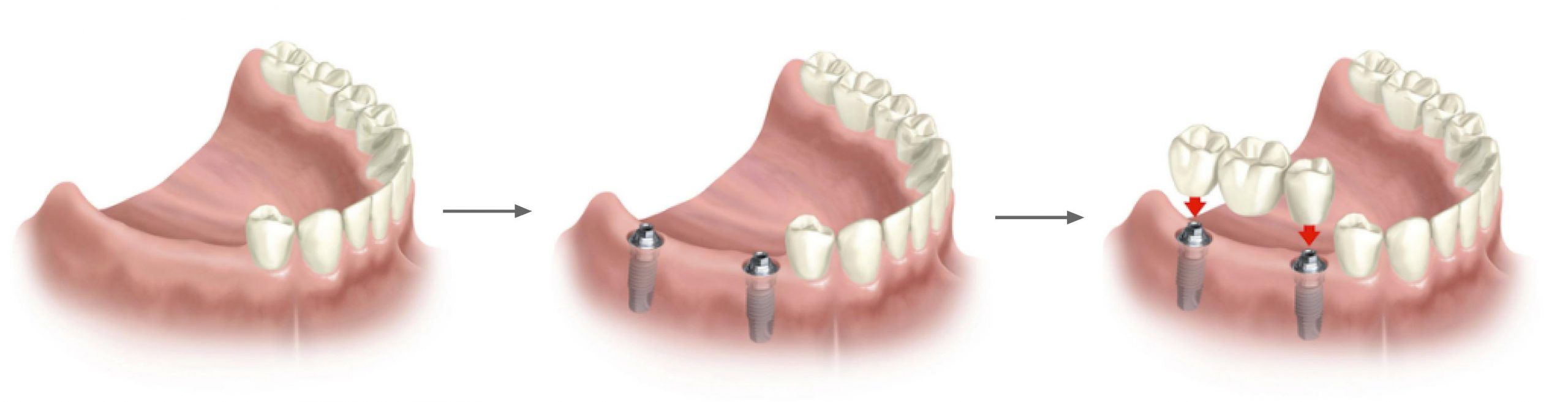 Proceso de colocación de un implante dental en el maxilar