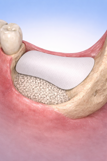 Membrana de PTFE protegiendo el injerto durante la cicatrización