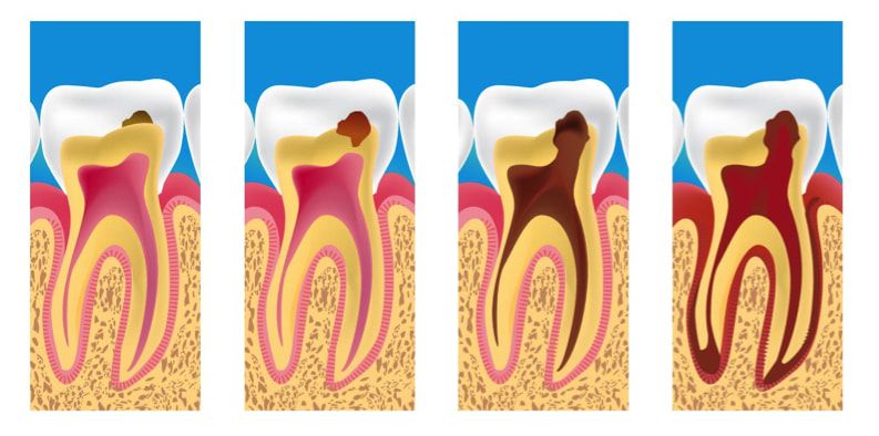 Fases de la caries dental: del esmalte a la pulpa