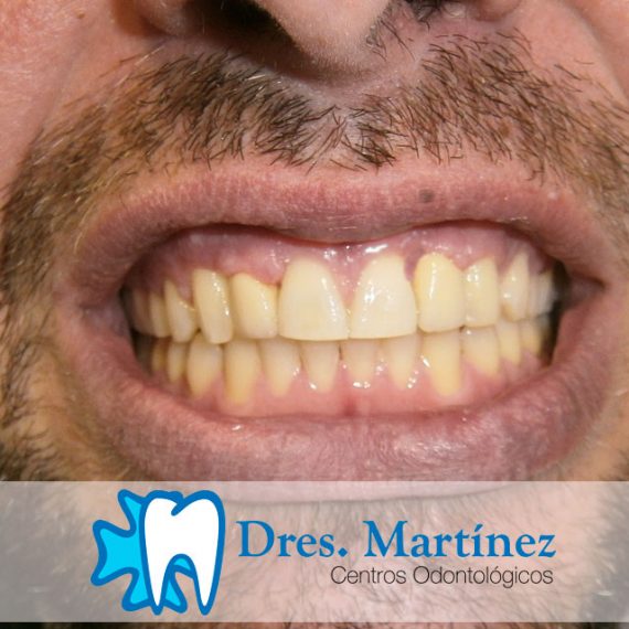 agenesia-dental-tratada-con-ortodoncia-dentistas-madrid