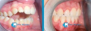 ortodoncia-en-adolescente-madrid-cuidad-real