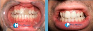 Corona de zirconio en diente necrosado por traumatismo dental