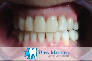 Solución-afección-periodontal-y-ortodoncia-con-brackets-de-zafiro-madrid-ciudad-real