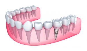 implantes-dental-madrid-ciudad real