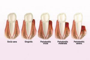 periodontitis madrid