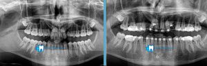 caso-clinico-de-incisivos-incluidos-radiografia-de-inicio-y-a-los-6-meses-dentistas-madrid