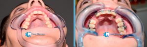 caso-clinico-de-incisivos-incluidos-superiores-inicio-y-4-meses-dentistas-madrid