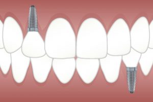 implantes dentales Valdebebas
