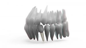 implantes dentales de inmediato